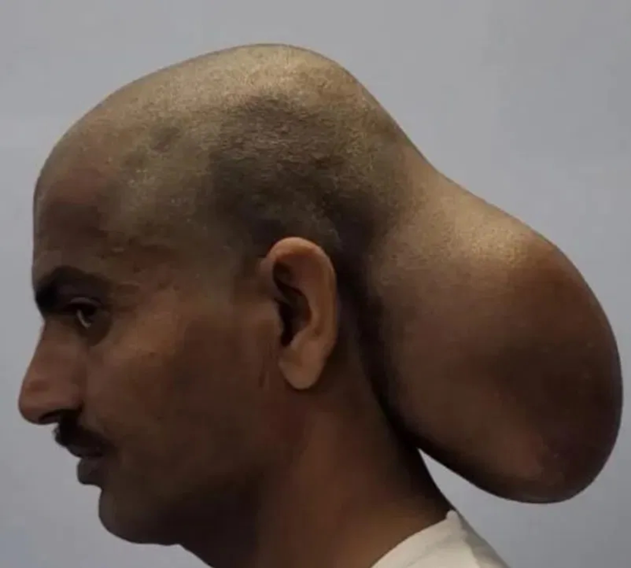 اكتشاف طبيّ مدهش: رجل هندي يعيش 15 عامًا مع ورم عملاق يشبه رأسًا ثانيًا