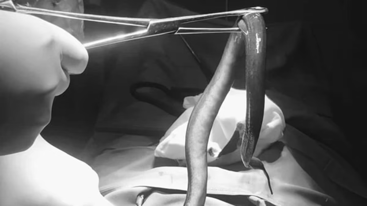اكتشاف ثعبان حي في معدة رجل بعد آلام مبرحة: حالة نادرة تدهش الأطباء