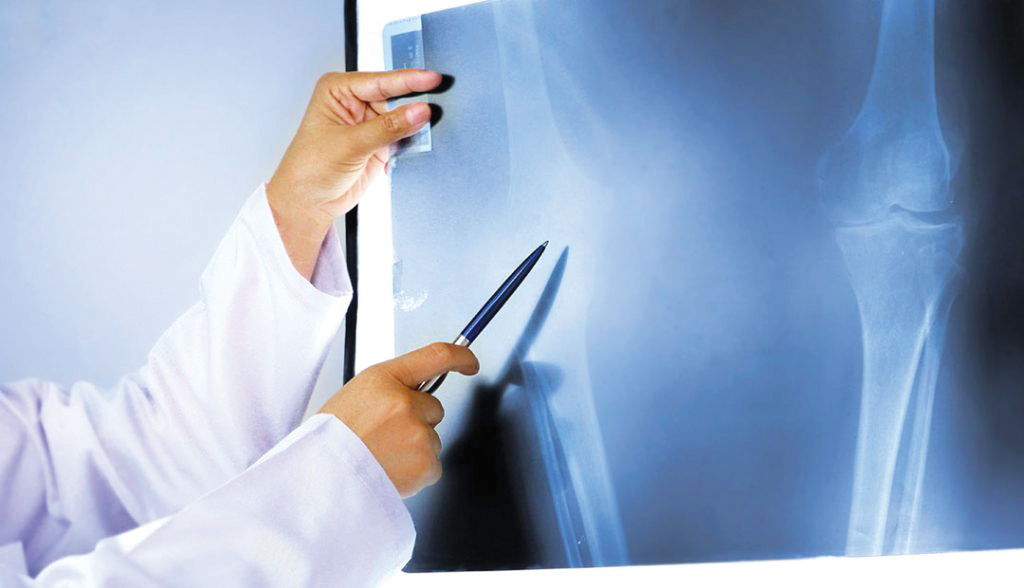 تقنية مبتكرة للمفاصل الصناعية: جامعة فليندرز الأسترالية تقلل من خطر العدوى وتعزز نمو العظام