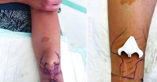 نجاح زراعة أنف على ذراع امرأة قبل نقله لوجهها