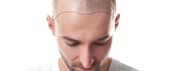 هل وجد العلماء علاجاً ثورياً للصلع أخيراً؟
