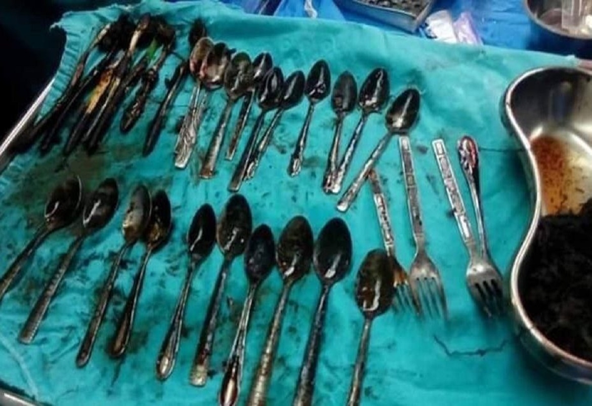 استخراج 24 ملعقة وشوكة و7 فرش أسنان وخاتم وسلسلة من معدة مريض مصري
