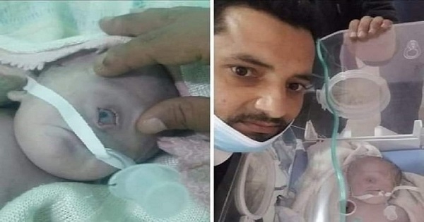 ولادة طفل بعين واحدة في اليمن