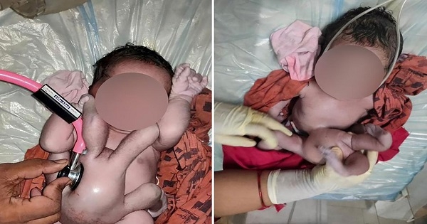 ولادة طفلة بـ 4 أذرع و4 أرجل