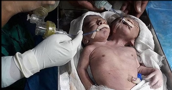 في حالة نادرة جداً .. ولادة طفل برأسين و3 أذرع 